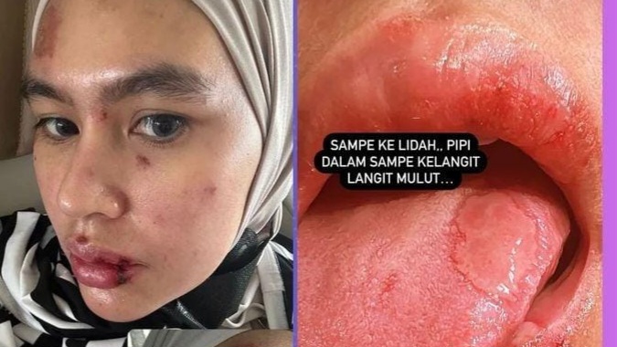 Wajah Hingga Lidah Kartika Putri Melepuh, Sampai Harus Berobat ke Singapura, Apa Penyebabnya