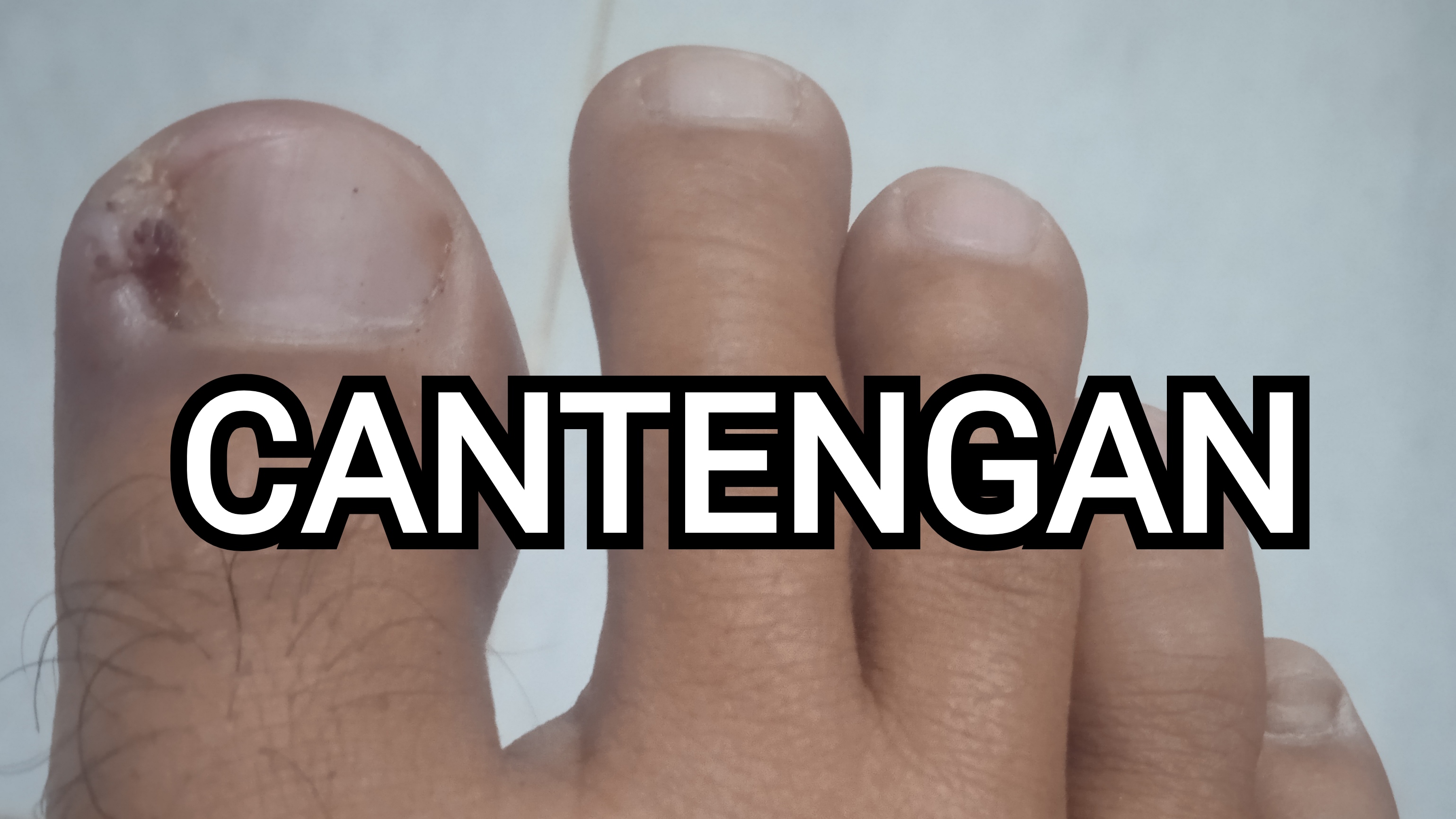 Simak, ini Cara Mengobati Kuku Cantengan yang Efektif 