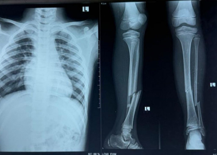 Panitia PGRI Cup Lubuk Linggau Bertanggung Jawab, Club Muratara Didiskualifikasi, Insiden Pemain Patah Kaki 