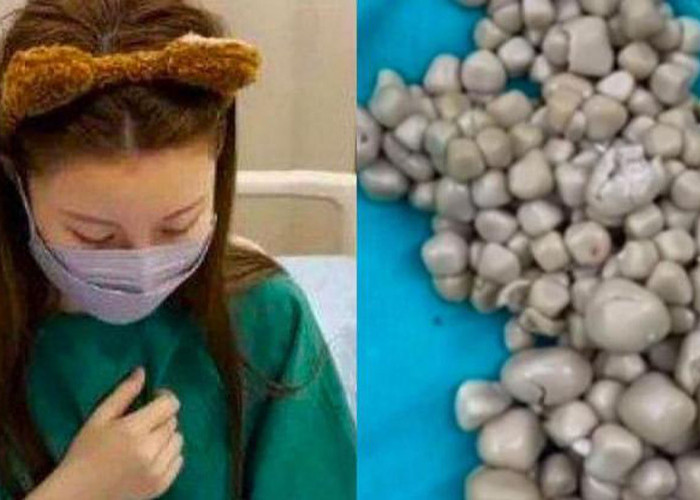 Dokter Taiwan Temukan 300 Batu Ginjal di Tubuh Wanita Muda, Penyebabnya Jarang Minum Air Putih