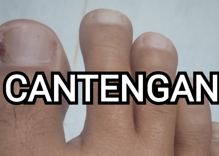 Simak, ini Cara Mengobati Kuku Cantengan yang Efektif 