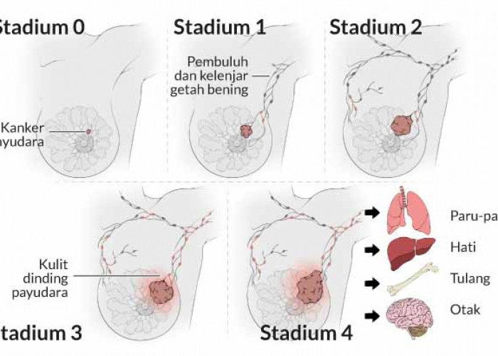 Kanker Payudara: Kenali Ciri-Ciri dan Gejala dari Stadium 1 hingga 4